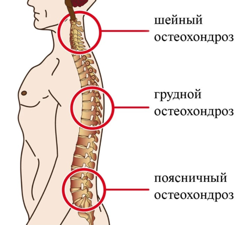 Остеохондроз