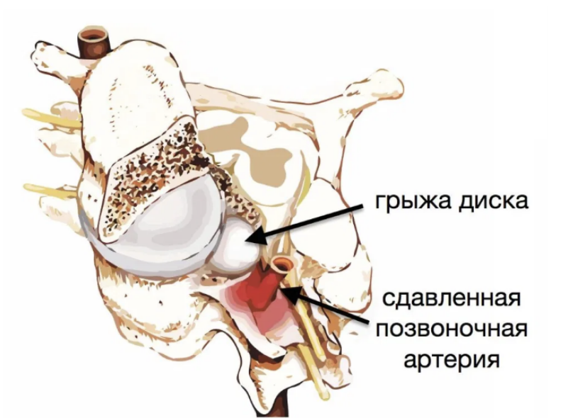 Сдавленная позвоночная артерия