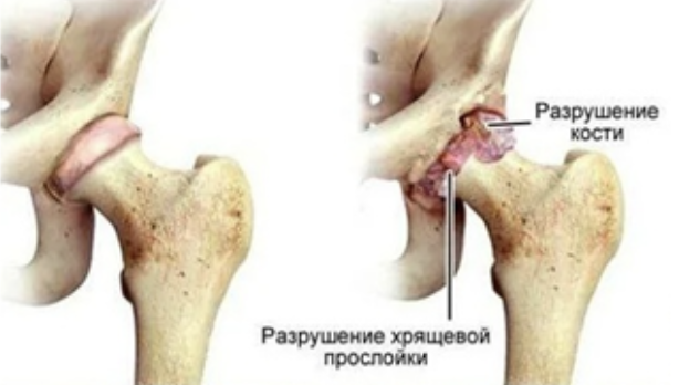 Разрушение хрящевой прослойки