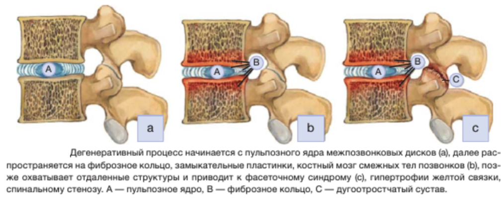 Дегенеративные и дистрофические изменения