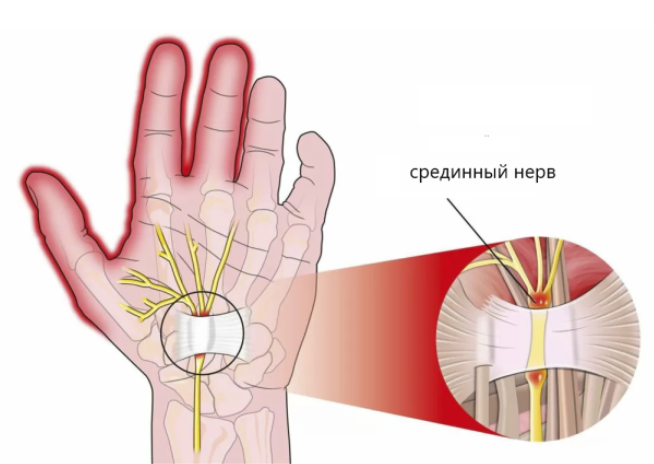 Основные признаки синдрома запястного канала