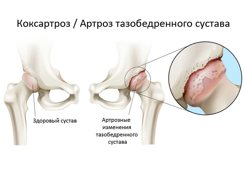 Поворачивание ребенка на один бок