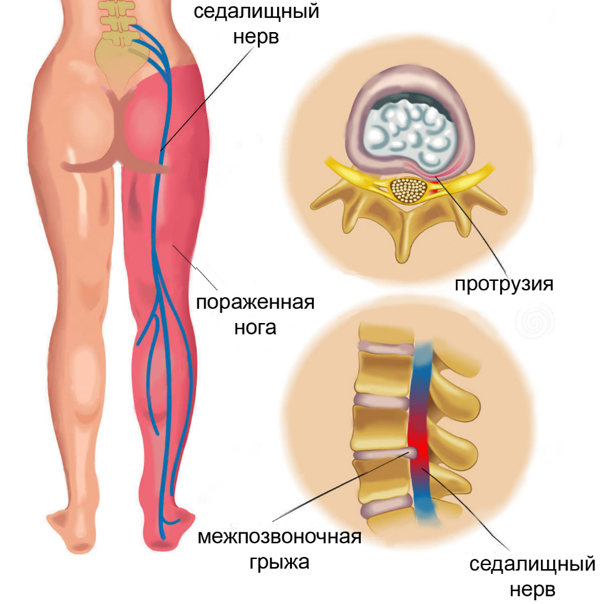 Боль в грудной клетке или спине - Расстройства пищеварения - Справочник MSD Версия для потребителей