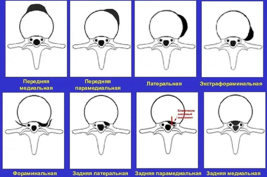 Грыжа шейного отдела позвоночника: причины, симптомы и лечение