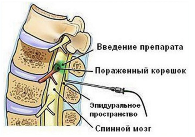 Крестцовый остеохондроз, его симптомы, лечение и профилактика