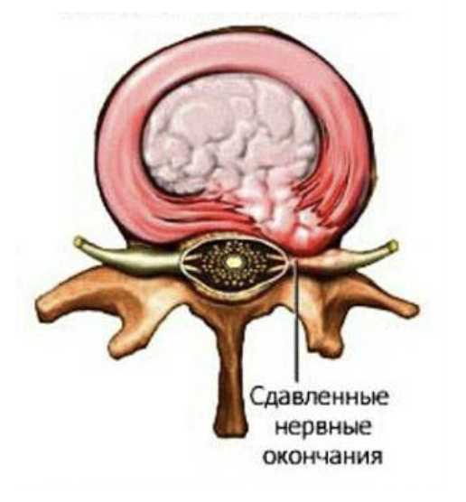 Грыжа позвоночника 8 мм