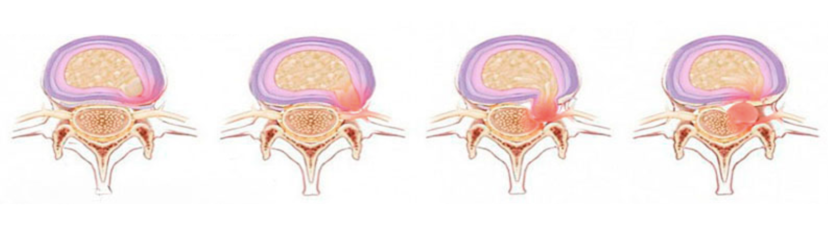 Секвестрированная грыжа поясничного отдела позвоночника фото