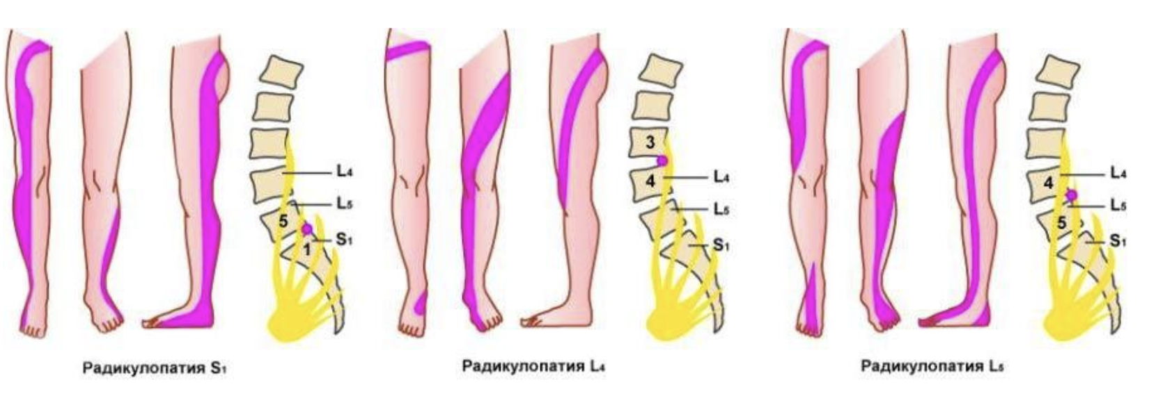 Грыжа может отдавать в поясницу. Радикулопатия диска l3-l4. Радикулопатия Корешков л5 с1. Радикулопатия l2-l3. Синдром корешка l4 диск l3-l4.