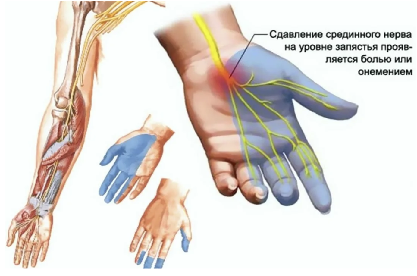 Причины онемения кончиков пальцев на руках