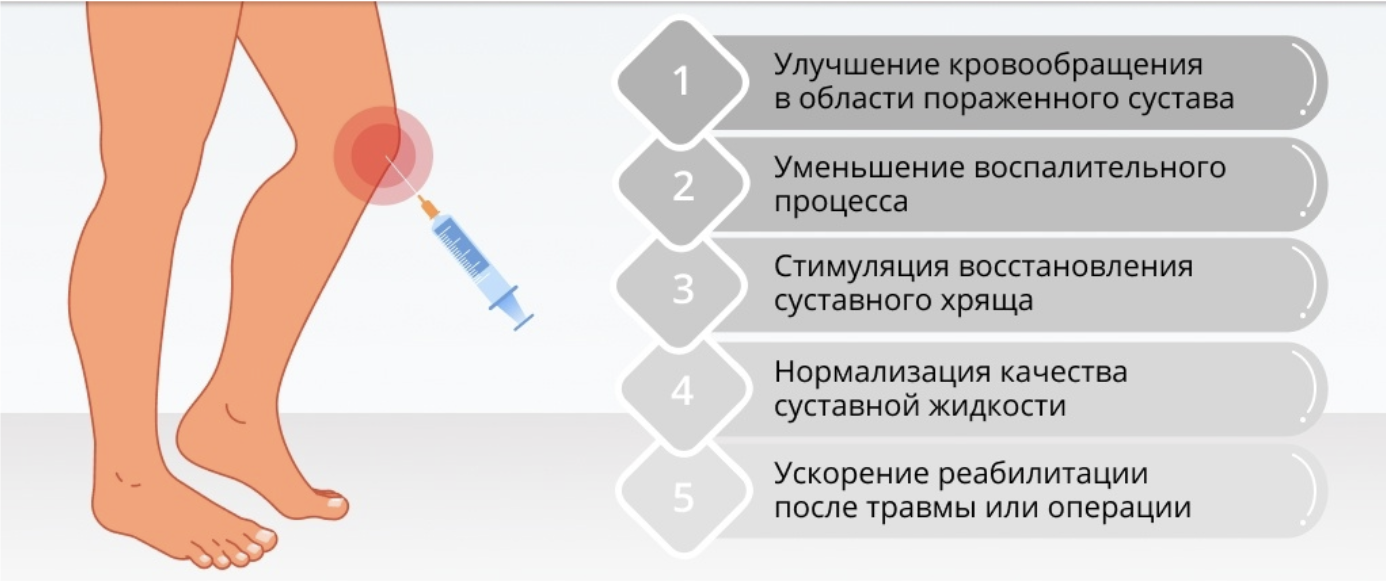 Симптомы гонартроза: причины, стадии и лечение