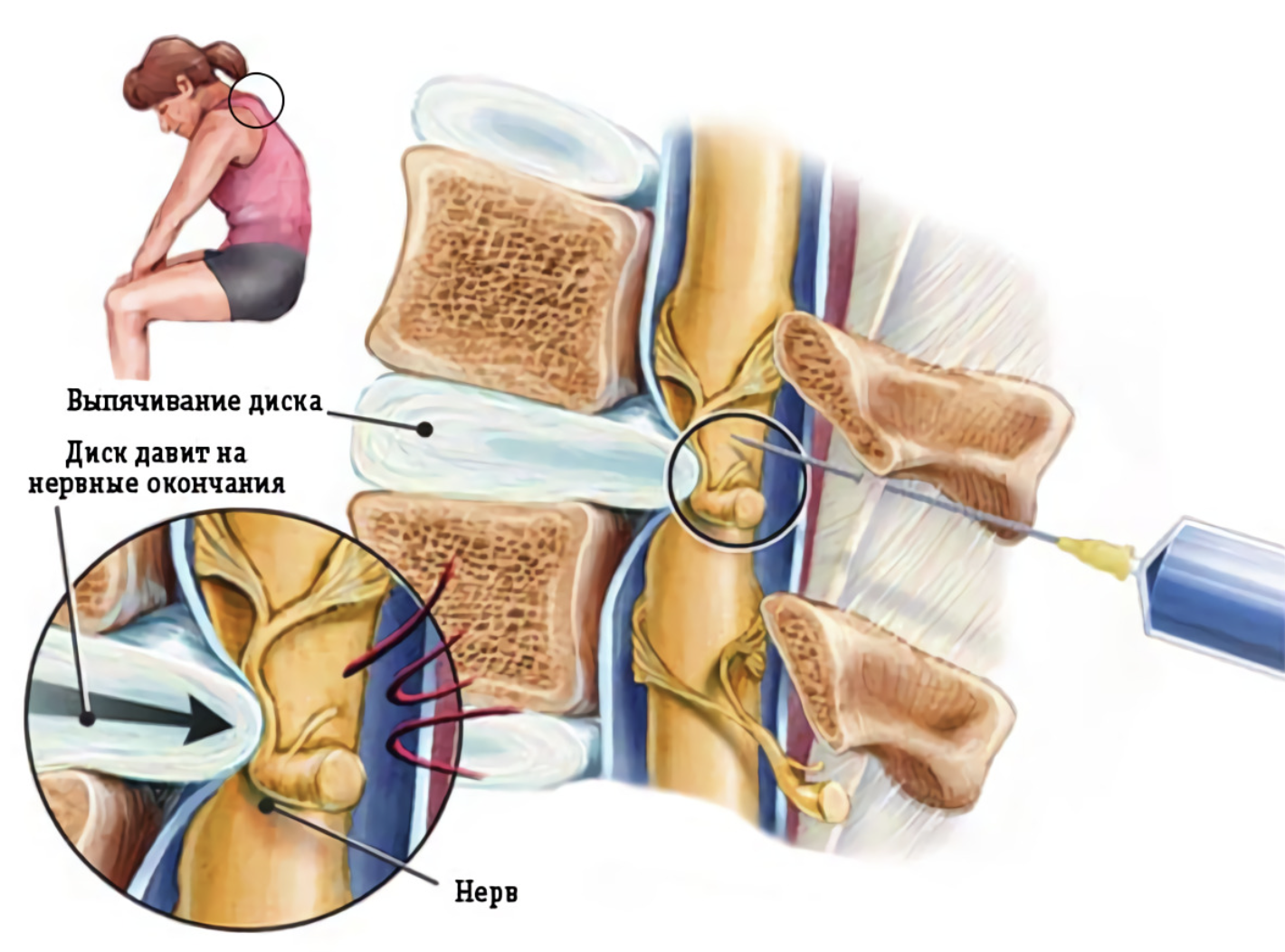Укол в позвоночник. Блокада грыжи позвоночника при грыже. Блокада при грыже поясничного отдела. Паравертебральная, эпидуральная блокада. Эпидуральная блокада при грыже.