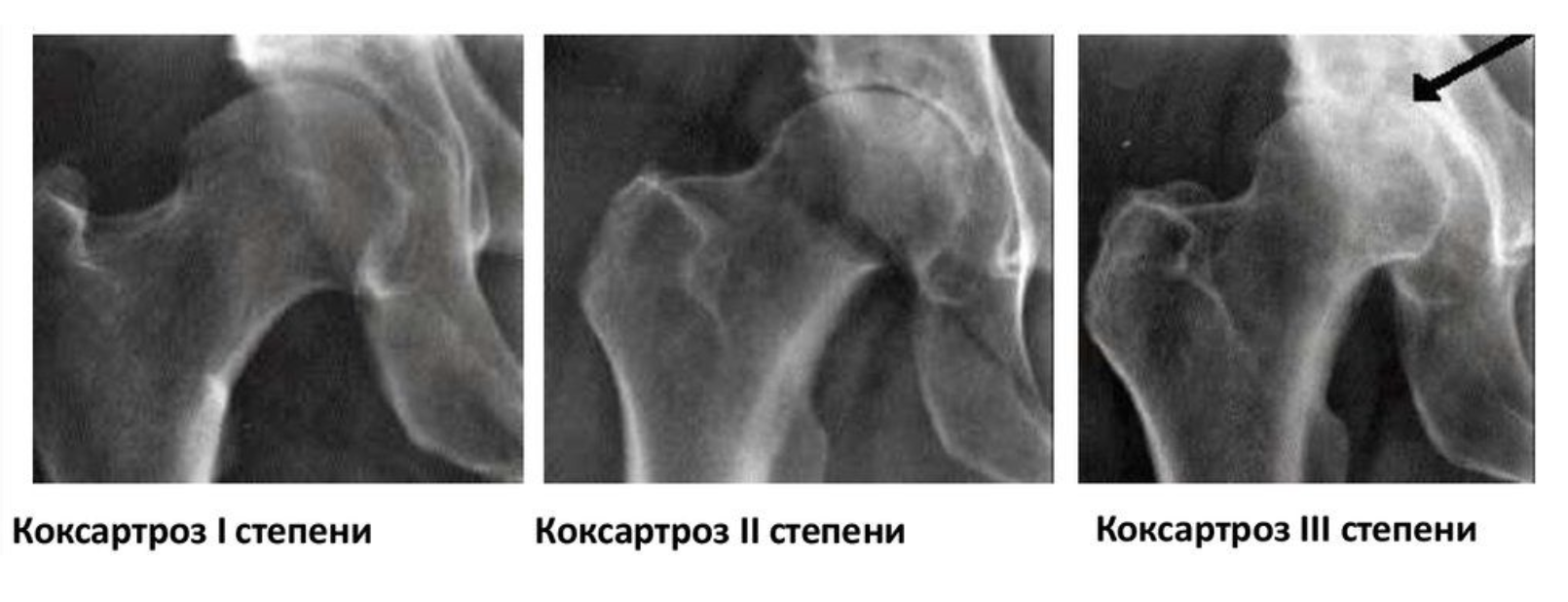 Коксартроз 1 степени симптомы и лечение