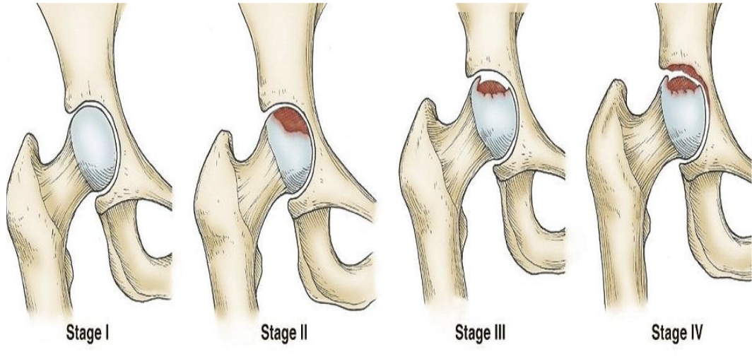 Асептический некроз головки бедренной кости: в группе риска — молодые и здоровые!