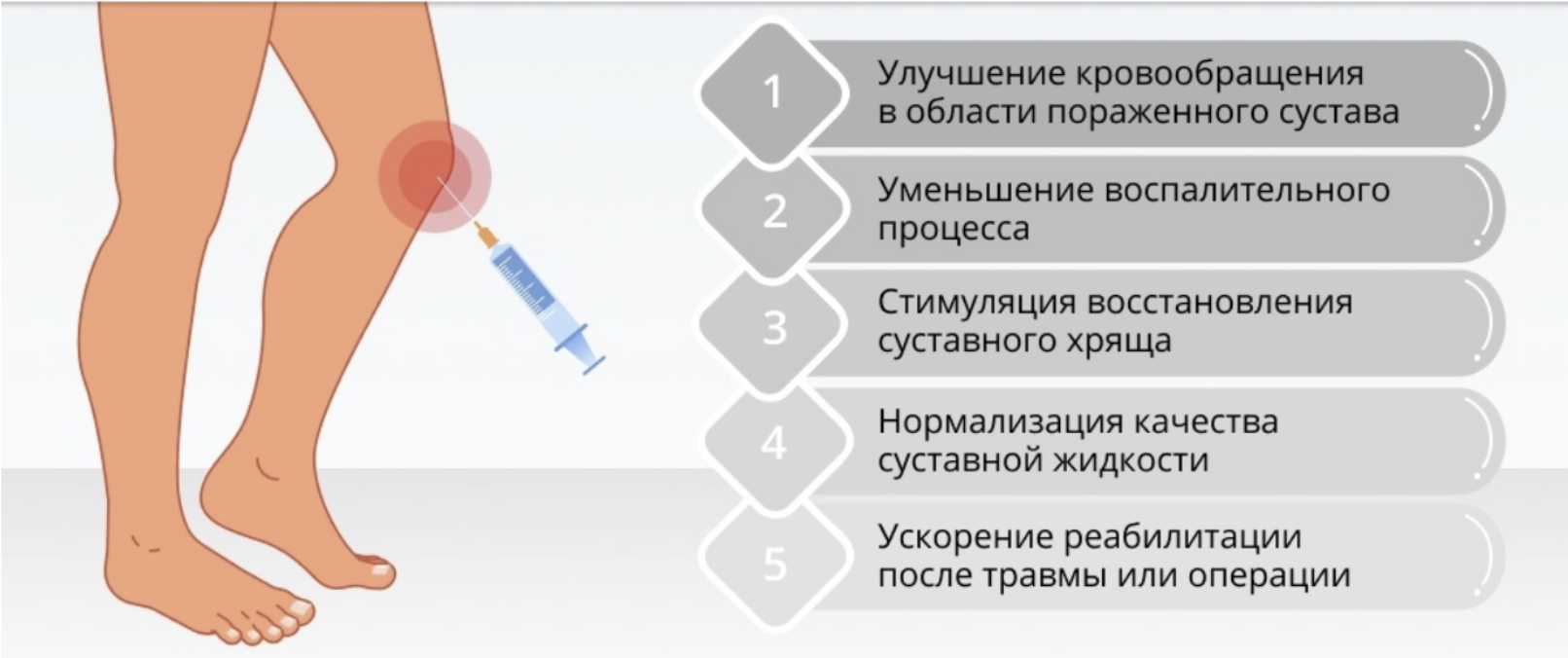 Гонартроз 2 стадии: причины, симптомы и лечение