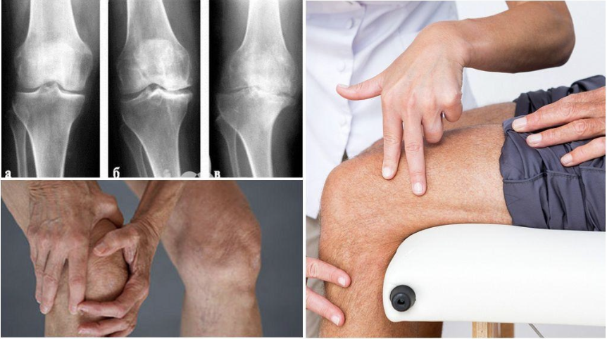 Артрит коленного сустава: симптоматика и лечение
