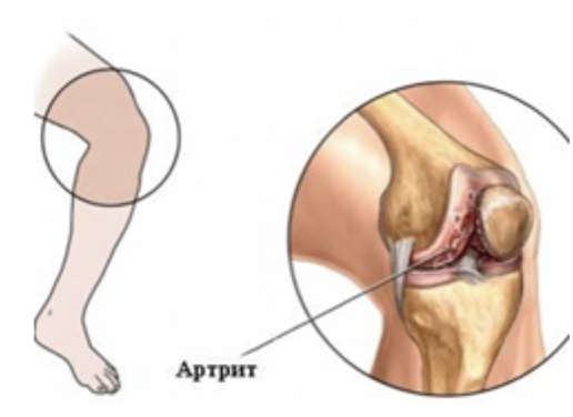 Артрит коленного сустава: симптомы, признаки и лечение в Москве