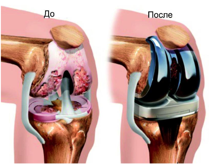 Артроз (гонартроз) коленного сустава - причины, симптомы, диагностика, лечение и профилактика