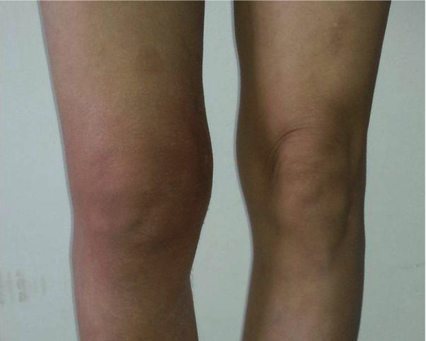 Синовит коленного сустава: разбор причин, способов диагностики и методов лечения