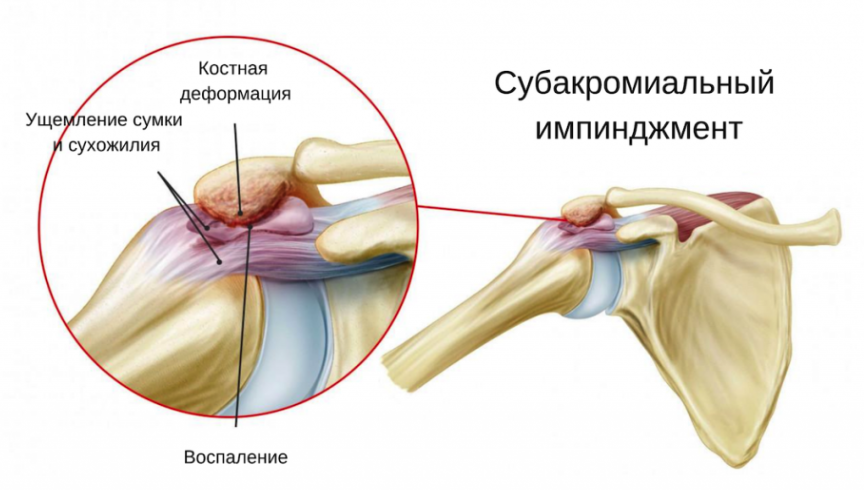 Какой врач лечит разрыв мышц плечевого сустава