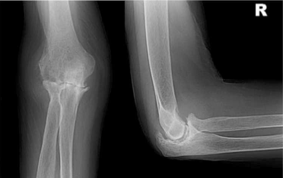 Артроз локтевого сустава. Ревматоидный артрит локтевого сустава. Ревматоидный артрит локтевого сустава рентген. Остеоартроз локтевого сустава рентген. Артрит локтевого сустава рентген.