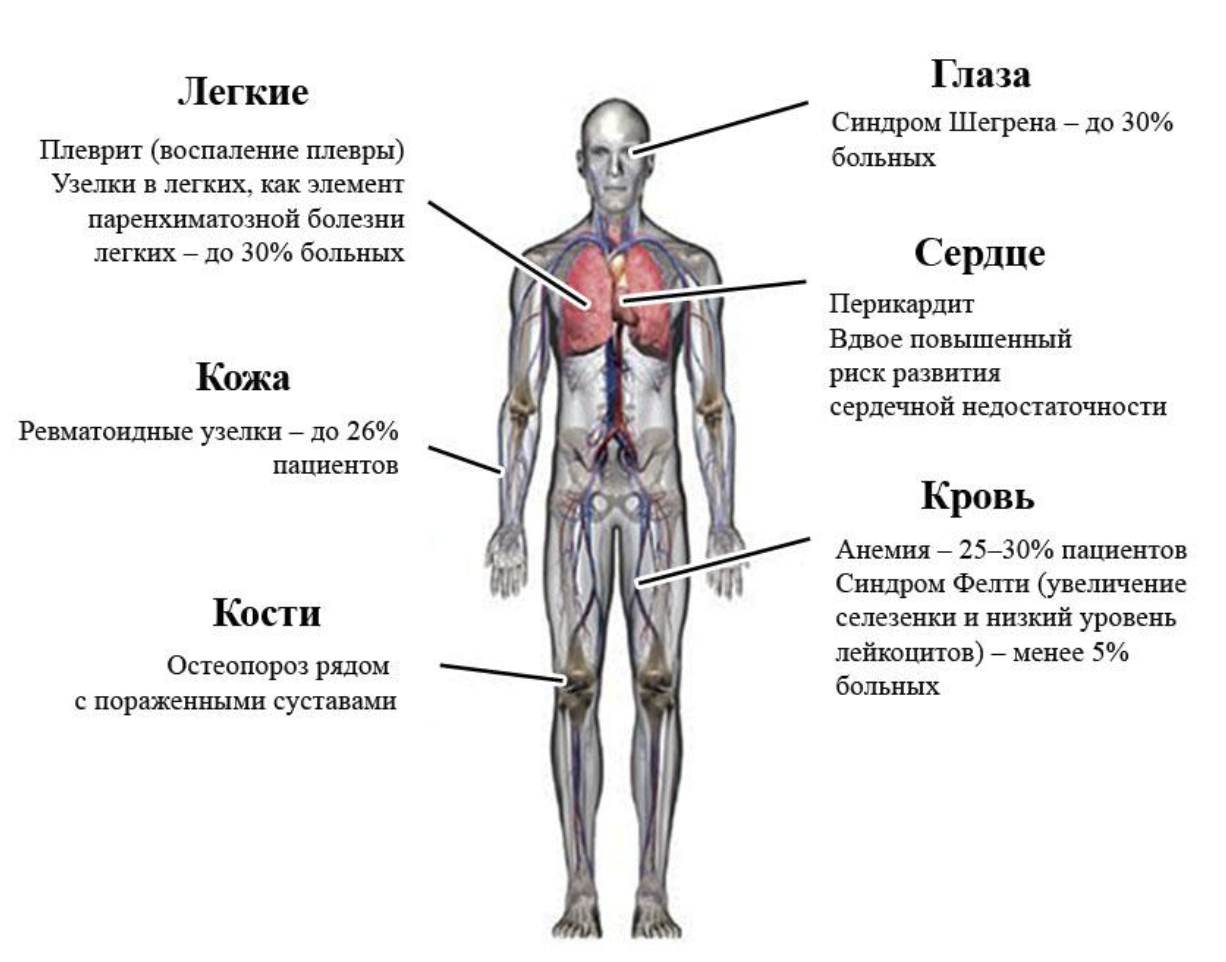 Как избавиться от болей при ревматоидном артрите