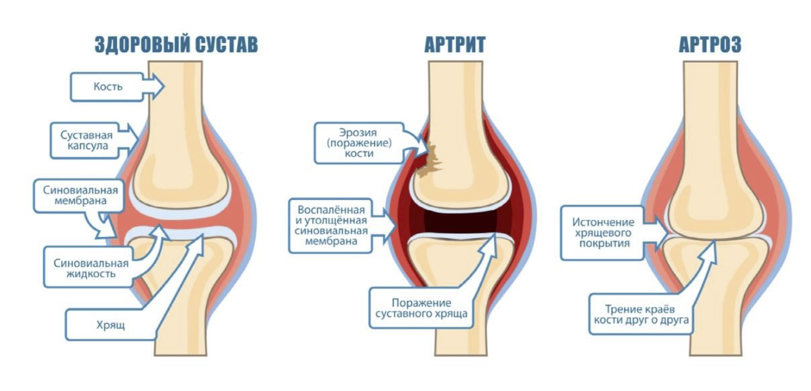 Артрит суставов: симптомы, диагностика, лечение - статьи от компании Еламед