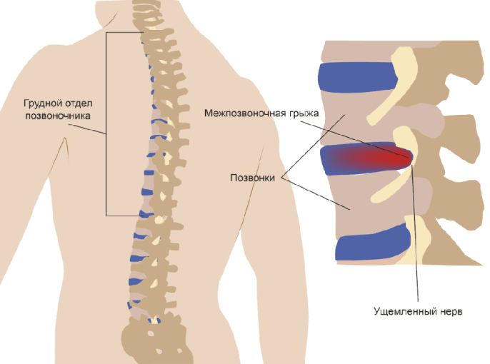 Остеохондроз грудного отдела – симптомы, причины, признаки, диагностика и лечение в «СМ-Клиника»