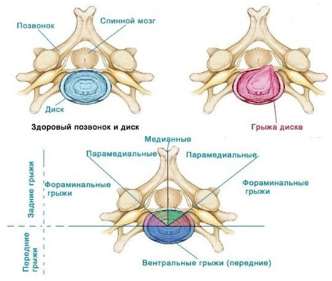 Медиальная грыжа шейного отдела. Грыжи межпозвоночных дисков классификация. Медианно-парамедианная билатеральная грыжа диска l5-s1. Задняя правосторонняя парамедианная грыжа диска l5-s1.