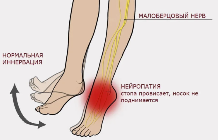 Что включает в себя ранняя диагностика невропатии малоберцового нерва