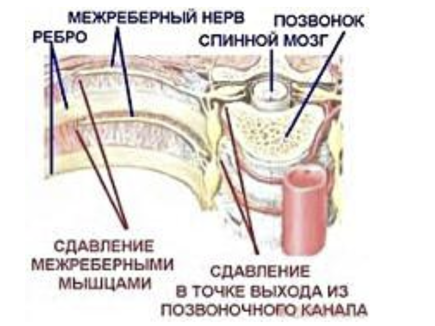 Чем лечить невралгию. Межреберная неврология. Межреберная невралгия фото. Межреберная невралгия лекарства. Межреберная невралгия уколы.