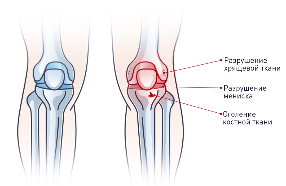 Надрыв связок колена, частичный разрыв связок коленного сустава - travmasport