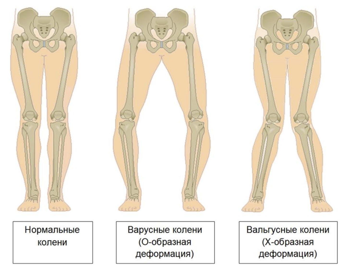 Вальгус это. Варусная деформация колена. Варусная деформация коленных суставов. Варусная деформация бедра. Варусная деформация конечностей.