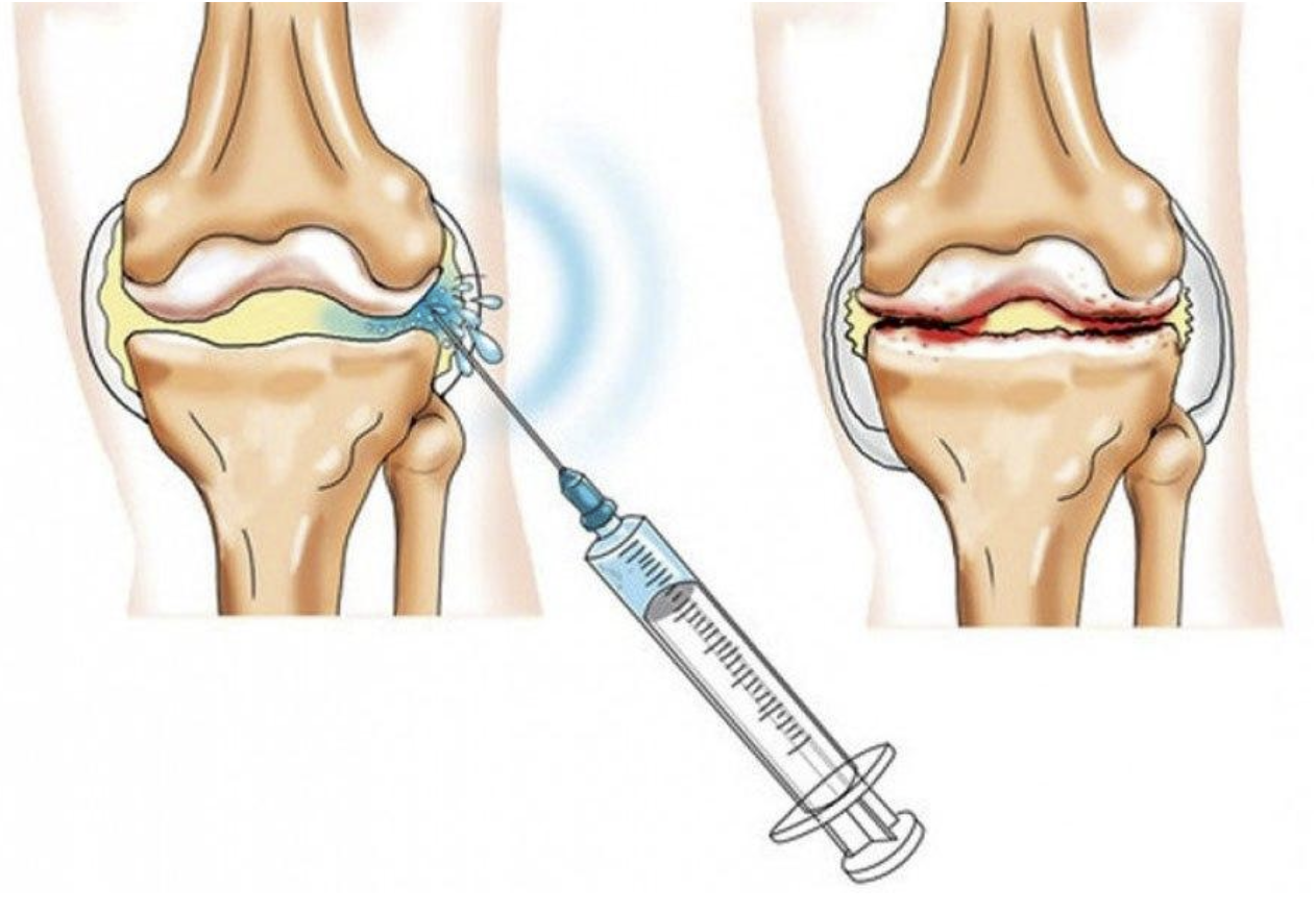 Протезы внутрисуставной жидкости. Внутрисуставные инъекции. Техника внутрисуставного введения в коленный сустав. Внутрисуставное Введение в плечевой сустав.