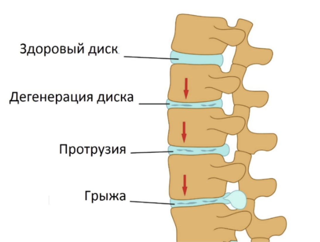Протрузия межпозвонковых дисков симптомы лечение. Протрузия диска позвоночника поясничного отдела. Протрузия дисков позвоночника что это такое. Протрузия l5 l6. Протрузии межпозвонковых дисков поясничного отдела позвоночника.