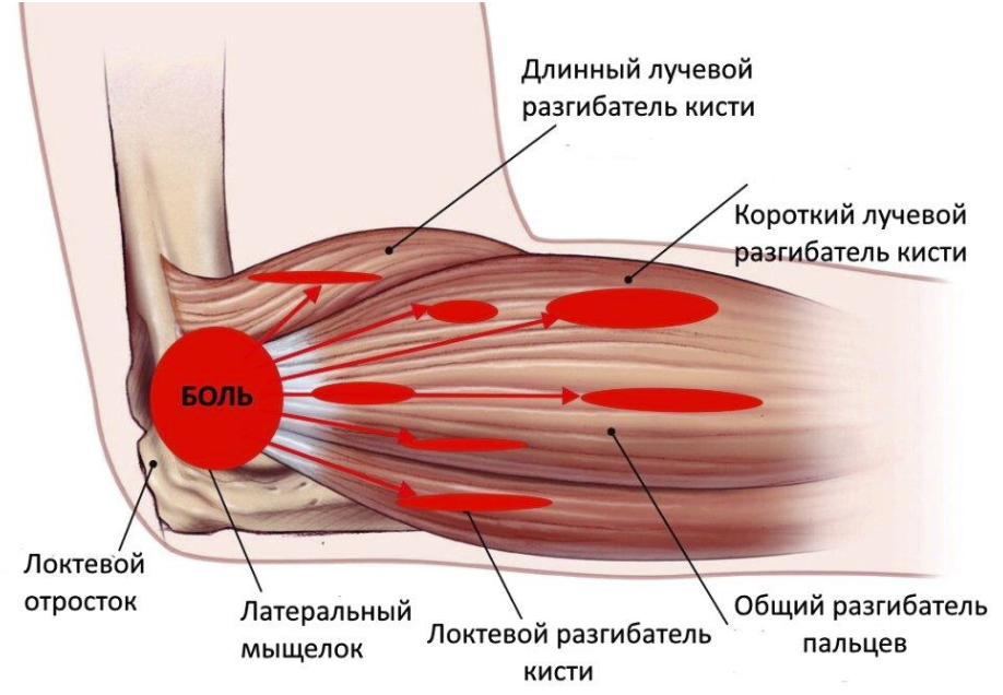 Блокада предплечья. Латеральный эпикондилит локтевого. Мышцы и сухожилия локтевого сустава. Сухожилие разгибателей локтевого сустава. Латеральный эпикондилит сухожилие.