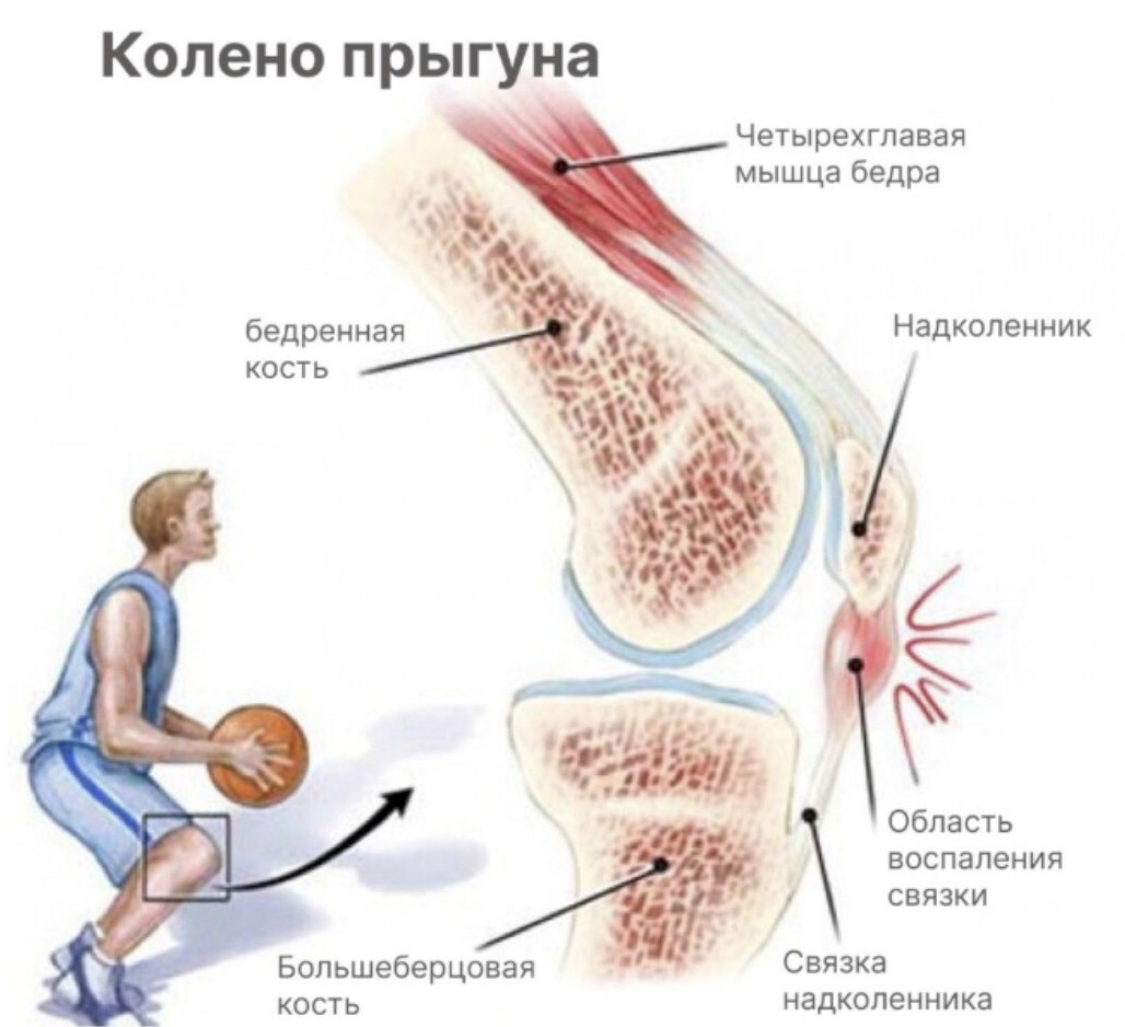 Травма коллатеральной локтевой связки - лечение, симптомы, причины, диагностика | Центр Дикуля