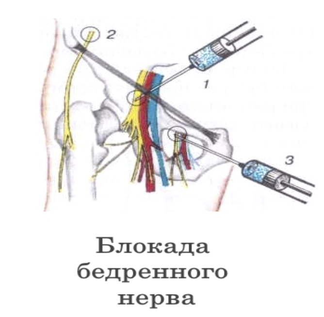 Бедренная невропатия лечение